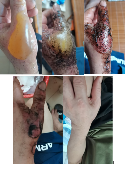 百草凝香守初心 古法新承惠万家——记基层民间中医代表唐玉琼与她的京华瑞烫伤膏